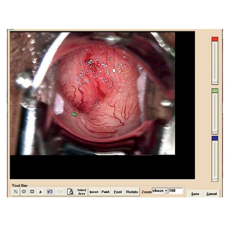 GIMA COLPOSCOPIO ALLTION A LED - 3 INGRANDIMENTI - 3.75X - 7X - 15X - 28.000 LUX