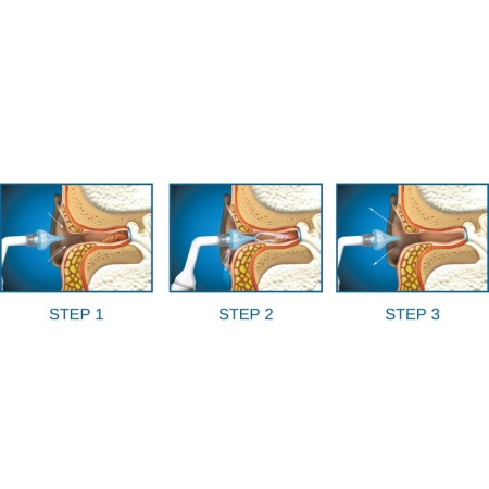 GIMA KIT SPRAY PER LAVAGGIO OTOCLEAR