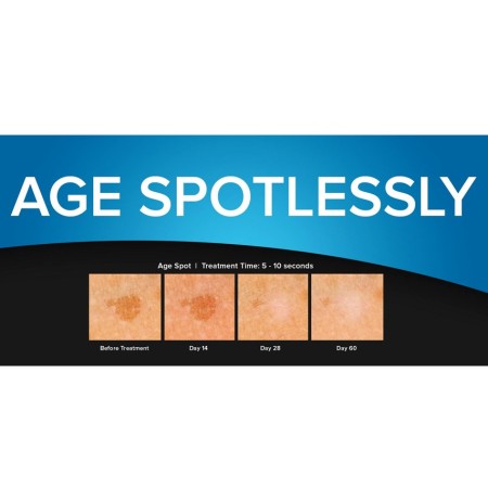 GIMA DISPOSITIVO CRIOCHIRURGICO CRYOCLEAR CON CARTUCCIA 16 G PER CRIOTERAPIA