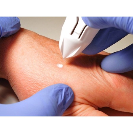 GIMA DISPOSITIVO CRIOCHIRURGICO CRYOCLEAR CON CARTUCCIA 16 G PER CRIOTERAPIA