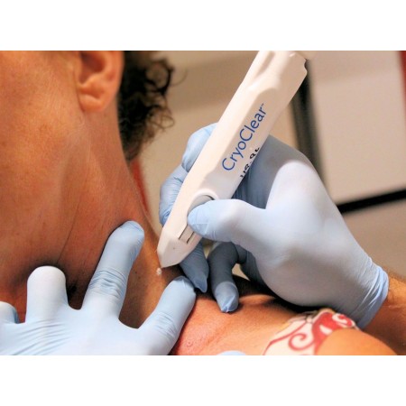 GIMA DISPOSITIVO CRIOCHIRURGICO CRYOCLEAR CON CARTUCCIA 16 G PER CRIOTERAPIA