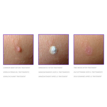 GIMA DISPOSITIVO CRIOCHIRURGICO CRYOMEGA CON CARTUCCIA 16 G