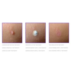 GIMA DISPOSITIVO CRIOCHIRURGICO CRYOMEGA CON CARTUCCIA 16 G