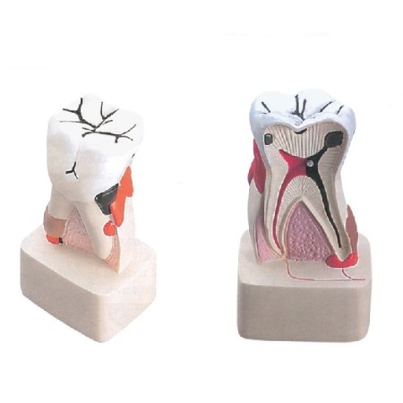 ALTAY SCIENTIFIC MODELLINO ANATOMICO PATOLOGIA DENTALE