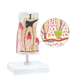 ALTAY SCIENTIFIC MODELLINO ANATOMICO MOLARE INFERIORE CON CARIE
