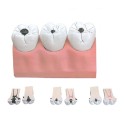 GIMA MODELLINO ANATOMICO CARIE DENTALE