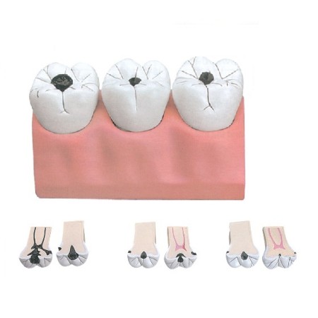 ALTAY SCIENTIFIC MODELLINO ANATOMICO CARIE DENTALE