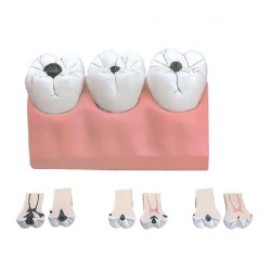 ALTAY SCIENTIFIC MODELLINO ANATOMICO CARIE DENTALE