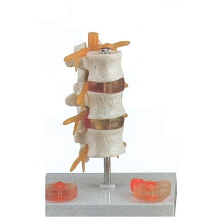 ALTAY SCIENTIFIC MODELLINO ANATOMICO PATOLOGIA ERNIA